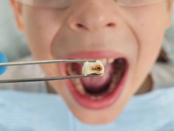 Best Emergency Dental Care for Broken or Chipped Teeth in Glen Rose, TX