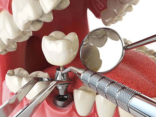 Best Urgent Care for Lost Fillings or Crowns in Glen Rose, TX