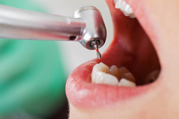 Best Emergency Treatment for Dental Infections or Abscesses in Glen Rose, TX